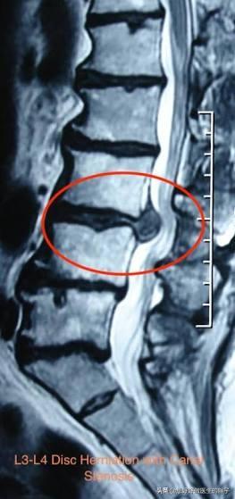 有些患者膝盖疼痛是由腰椎间盘突出压迫神经导致的，千万别忽视