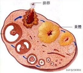 搬重物后黄体破裂,来月经扛重物黄体会不会破裂