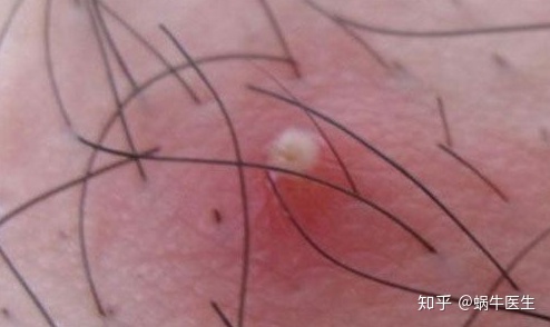 头皮除螨虫的正确方法,头皮上有螨虫用什么方法解决