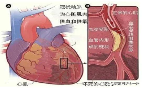 急性心梗的紧急处理视频,一旦发现急性心梗如何救