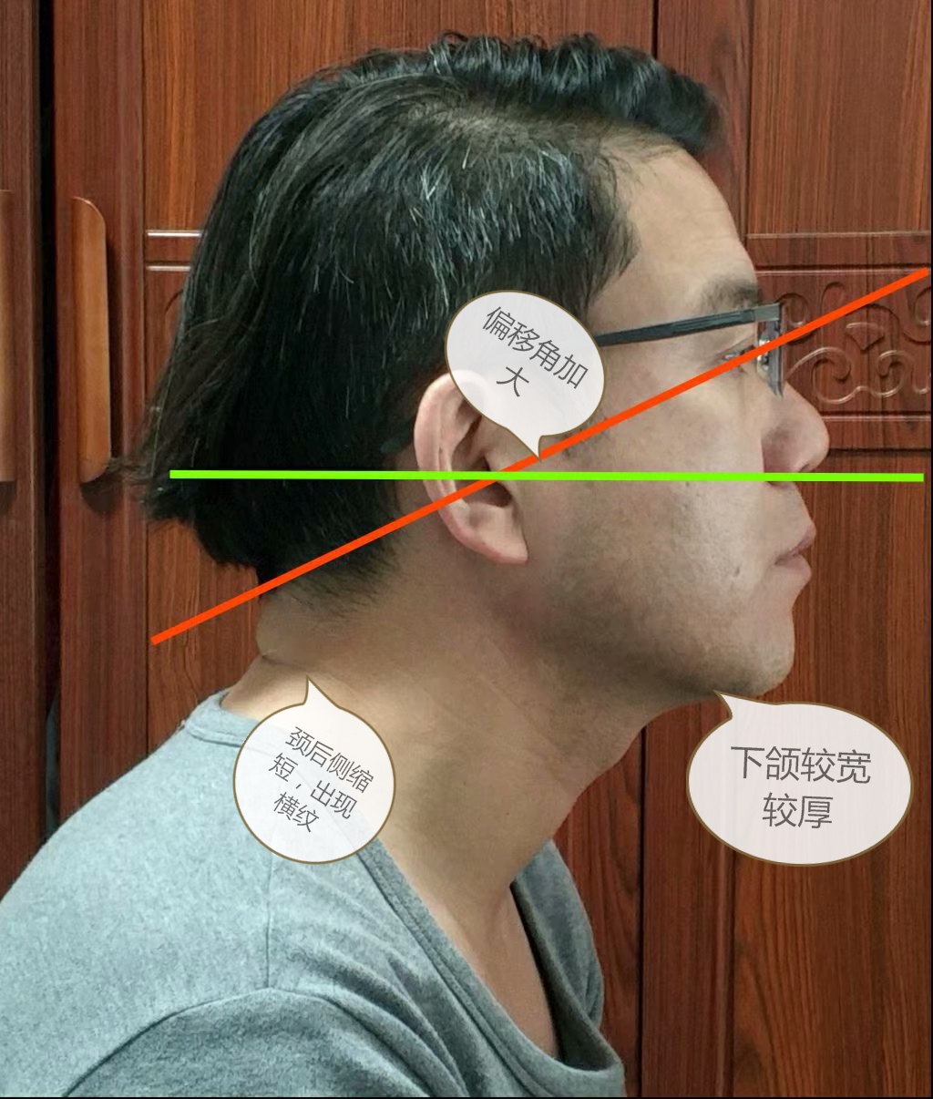 双下巴上有一坨肉向外凸,下巴多了一坨肉往前翘是太胖了吗
