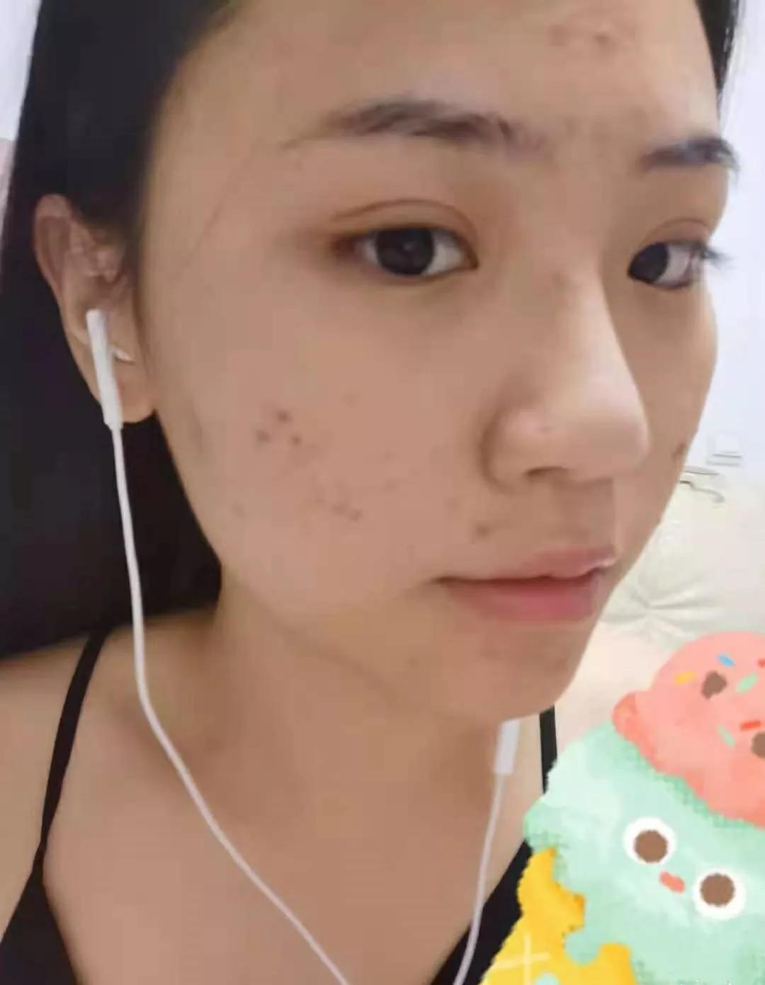 去皮肤科医院看痘痘,北京看痘痘好的皮肤科医院