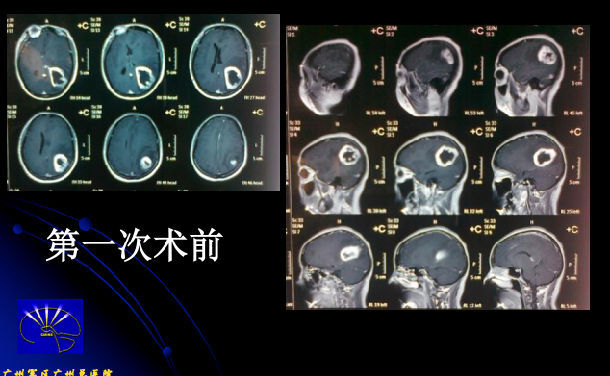 中医认为胶质瘤怎么来的,医学上什么叫胶质瘤