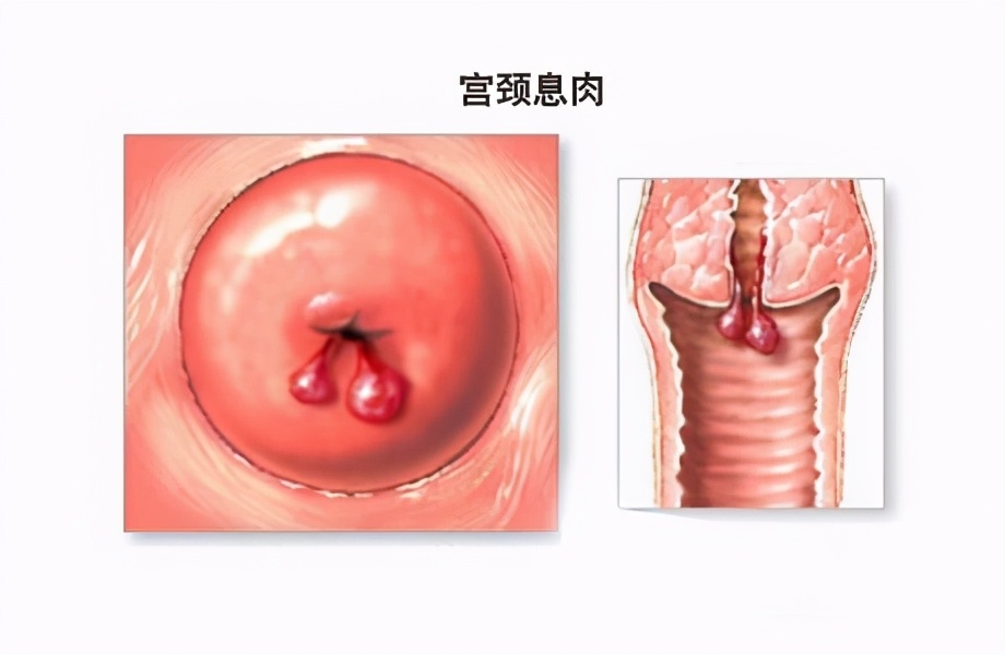 慢性宫颈炎传染吗,慢性宫颈炎严重吗好治愈吗