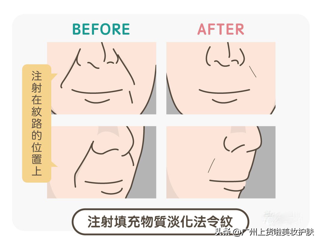 法令纹的种类和改善方法有哪些,法令纹比较深最有效的办法