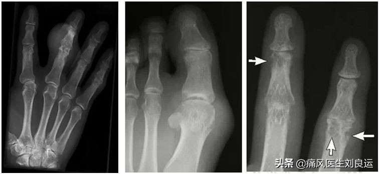 脚很痛不知道是扭伤还是痛风,脚痛不肿怎么判断是不是痛风