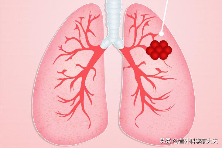 没手术的肺癌患者几年过危险期,没有靶向药的肺癌怎么治疗