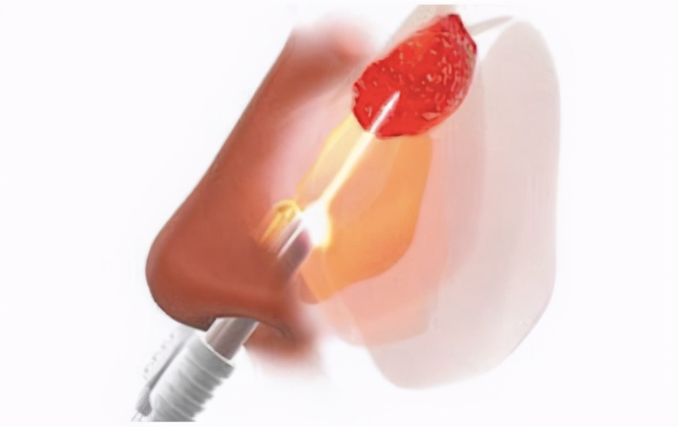 早期癌症会大出血吗,早期癌症如何发现