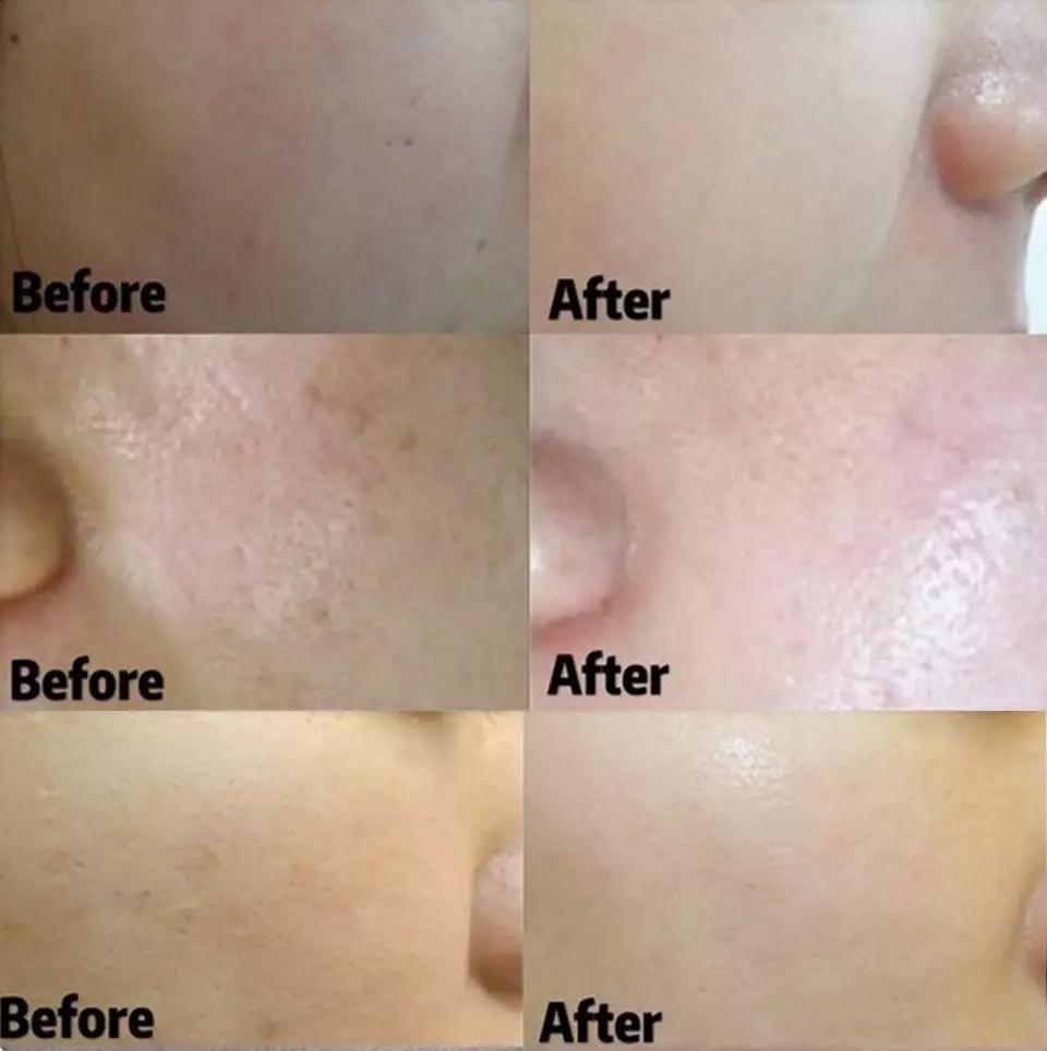 水光针真的比面膜好吗,1次水光等于1000张面膜