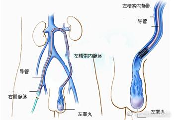 精索静脉曲张如果不管它行吗,得了精索静脉曲张不敢告诉家里人