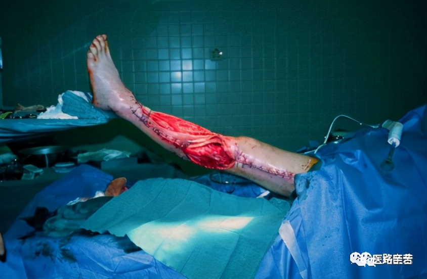 伤口换药技术操作流程视频,如何换药包扎伤口