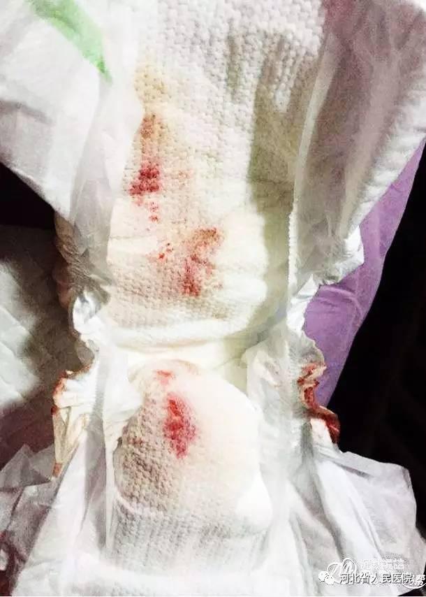 盘点新生儿特有的体征“符号”