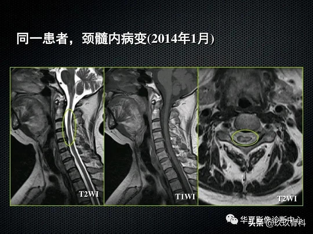 颈椎病脊髓变性mri表现,脊髓亚急性联合变性的诊断
