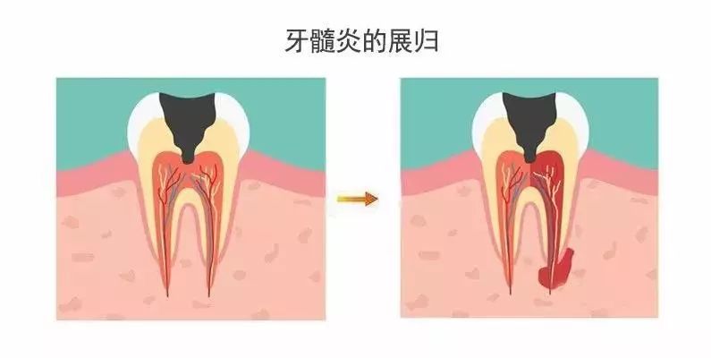 牙髓炎自愈的可能性,牙髓炎有办法自愈吗