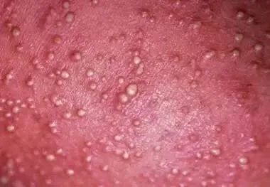 新生儿预防治疗痱子的介绍,新生儿痱子的最佳治疗方法