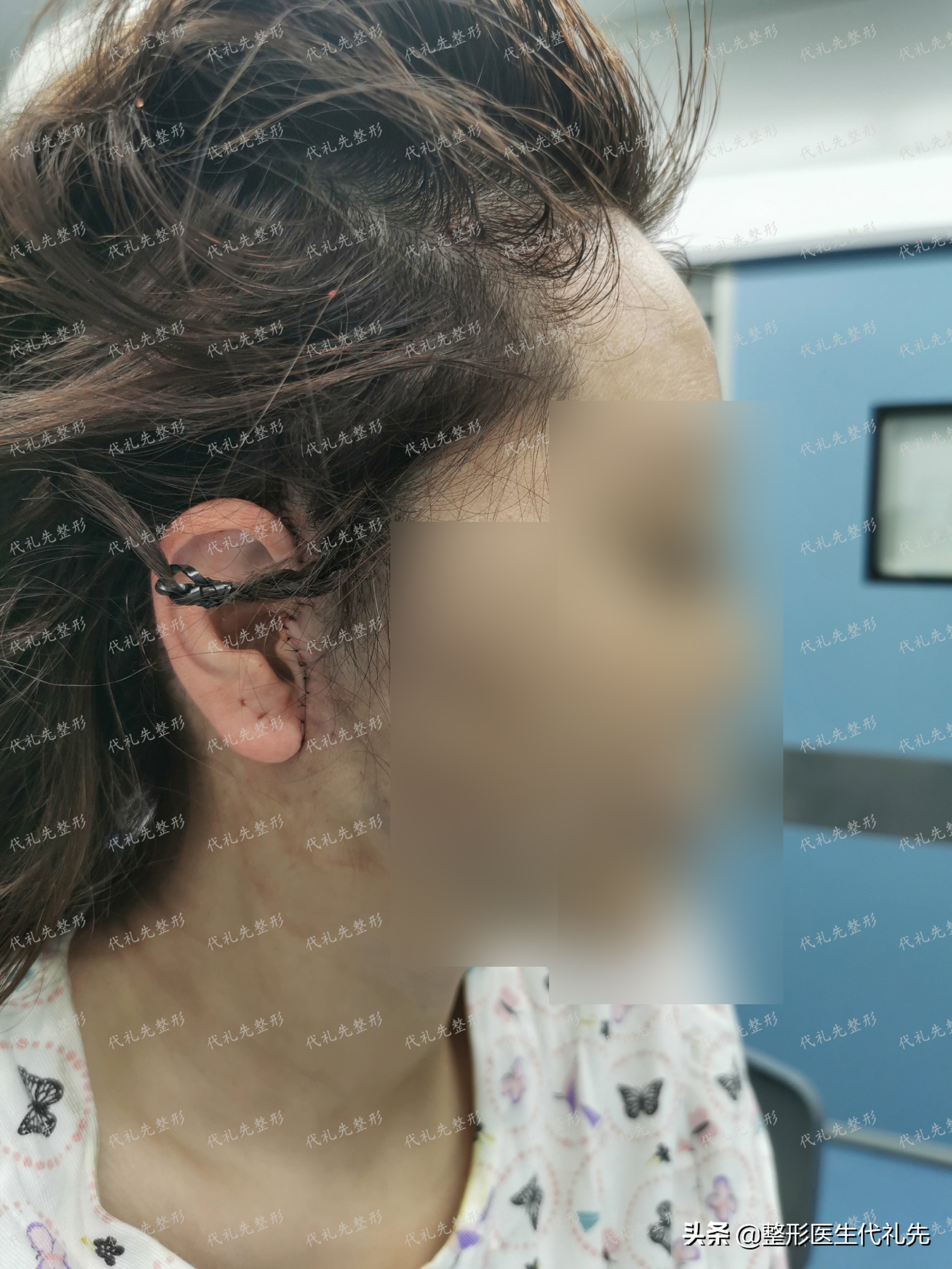 面部切皮提升手术,面部筋膜提升术和大拉皮