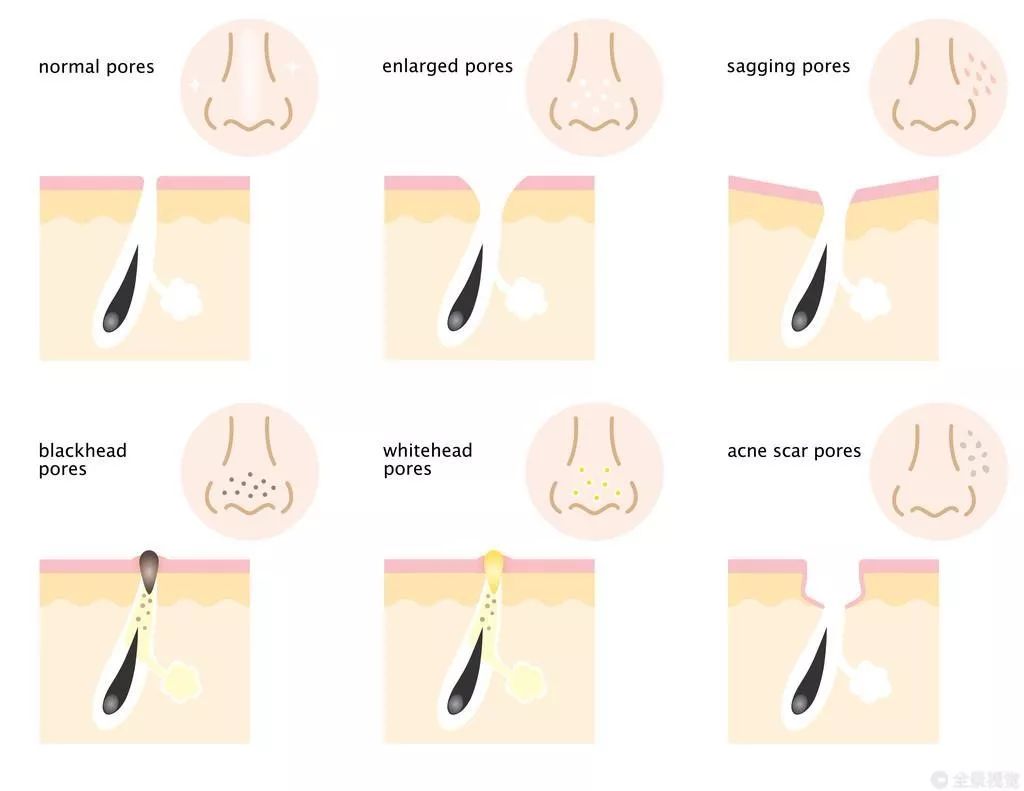 黑头粉刺甲硝唑凝胶怎么用,甲硝唑凝胶可以祛黑头粉刺吗