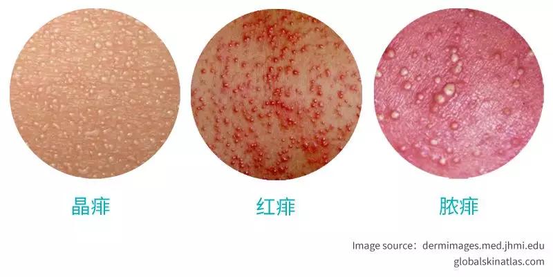 宝宝身上红点点是湿疹么,宝宝起湿疹和热痱子怎么区分