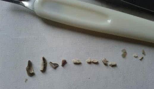 牙结石是什么东西,牙结石是什么东西啊图片