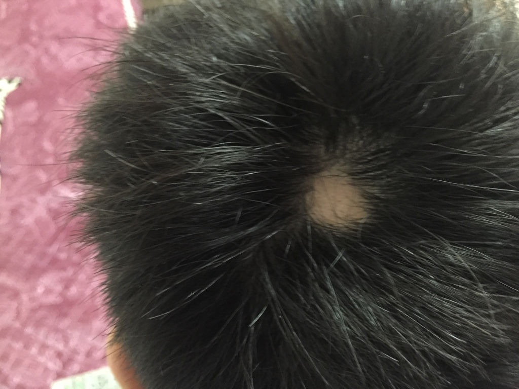 春季白癜风易复发这些因素莫忽视,得了白癜风怎么才能彻底治愈