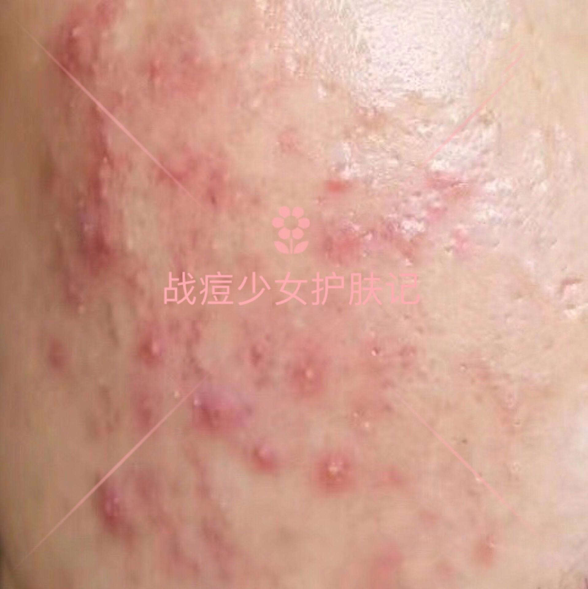 各种类型的痘痘怎么祛痘,痘痘六种类型上集