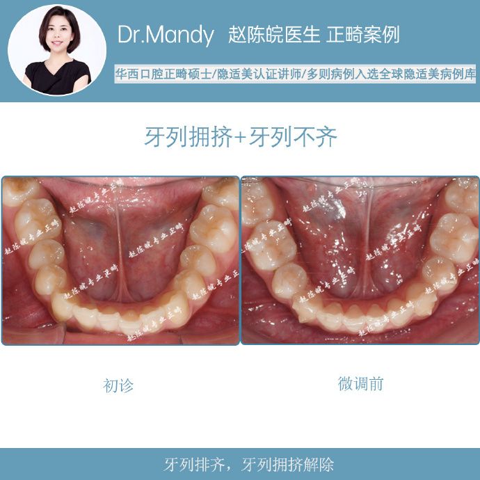 隐适美隐形矫正成功案例,经典隐形矫正