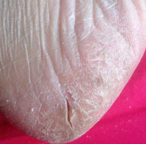 去角质灭真菌用什么,去角质最有效初学者