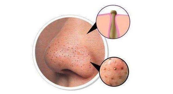 痘痘类型的黑头,痘痘黑头主要成分