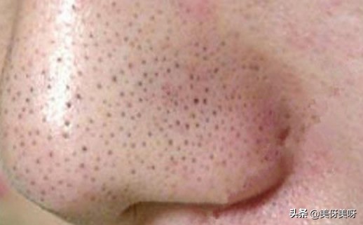 长黑头的原因和改善方法,黑头前面长出了白头怎么去掉