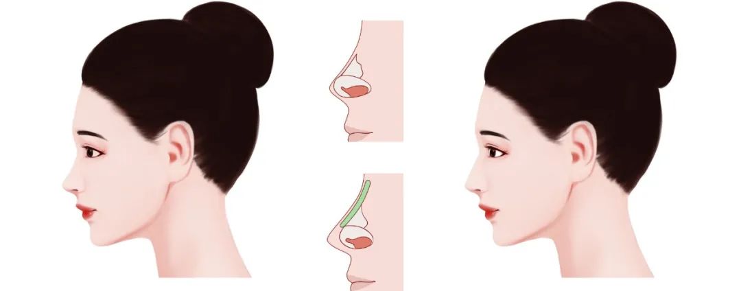 隆鼻材料你真的选对了吗,隆鼻哪种材料好你真的足够了解吗