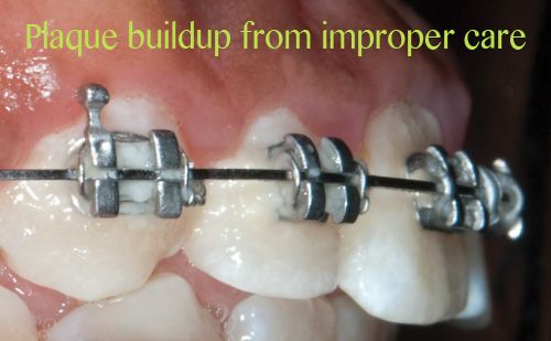 牙套要不要戴久一点再摘,牙套戴多久才不刮嘴