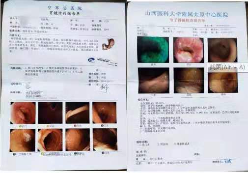 连续两年胃镜检查都有息肉,清风计划需要治疗吗