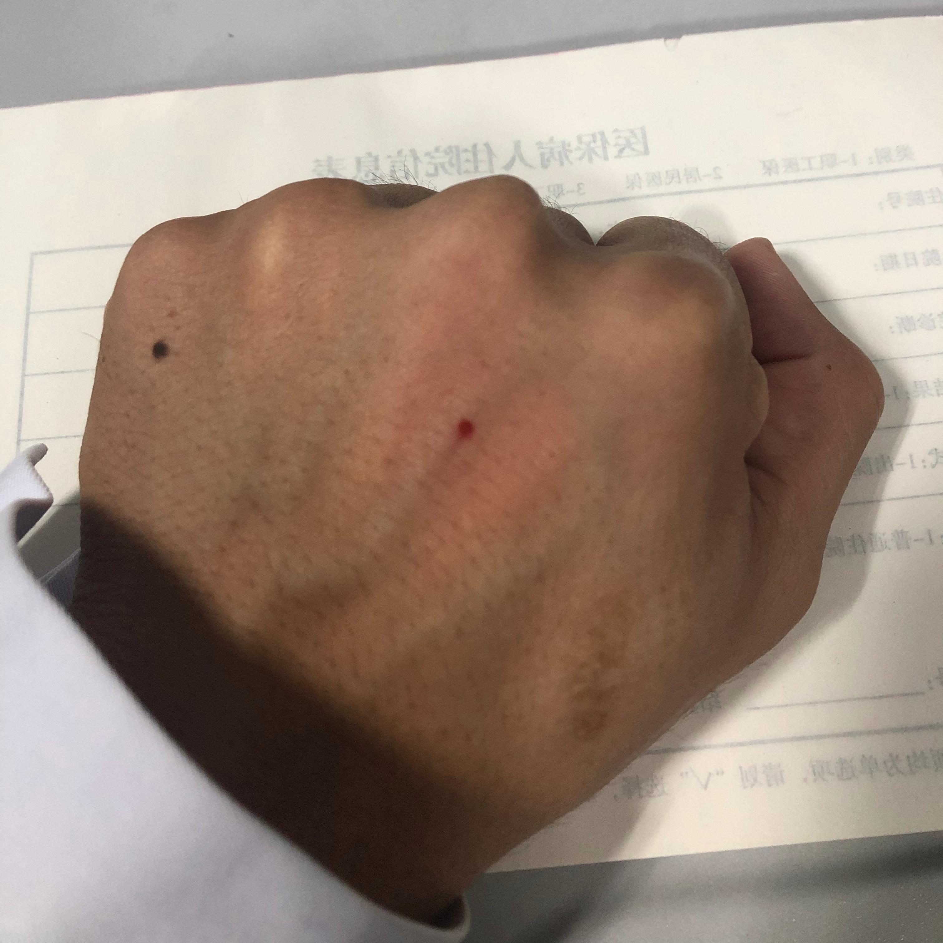 一针疗法高树中落枕,落枕针灸内关穴一针见效