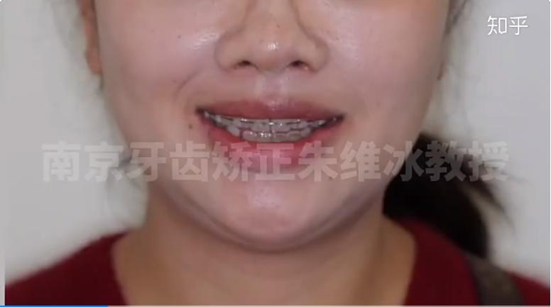 牙齿矫正骨开窗,骨壁比较薄牙齿矫正会骨开窗吗