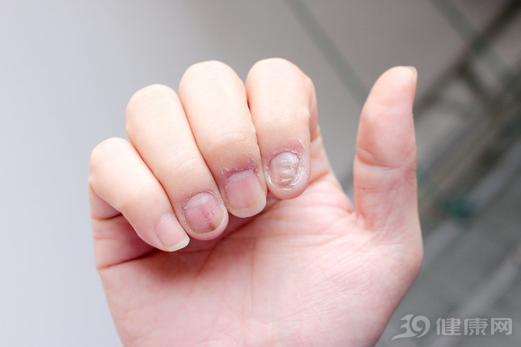 为什么患上灰指甲,为什么会得灰指甲怎么治