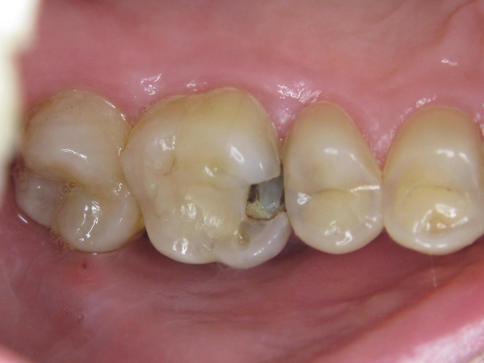 补牙是做嵌体修复好还是直接补好,补牙材料脱落修复