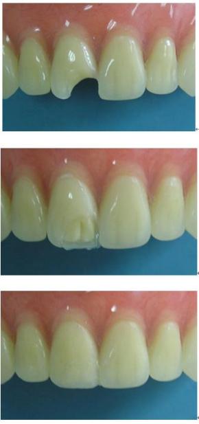 意外把牙磕碎了怎么找对方赔钱,牙齿意外断裂如何补救不伤牙