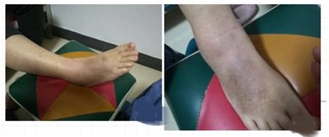 脚踝扭伤消肿散瘀针灸拔罐,脚扭伤消肿散瘀可以用拔火罐吗