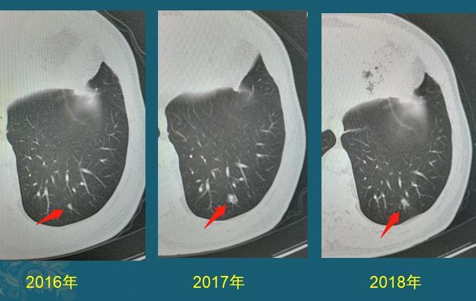 新冠肺部感染应对,新冠肺癌抗癌