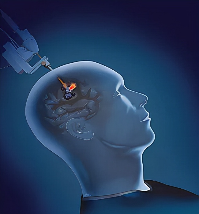 颅内海绵状血管瘤能治好吗,什么是颅内海绵状血管瘤