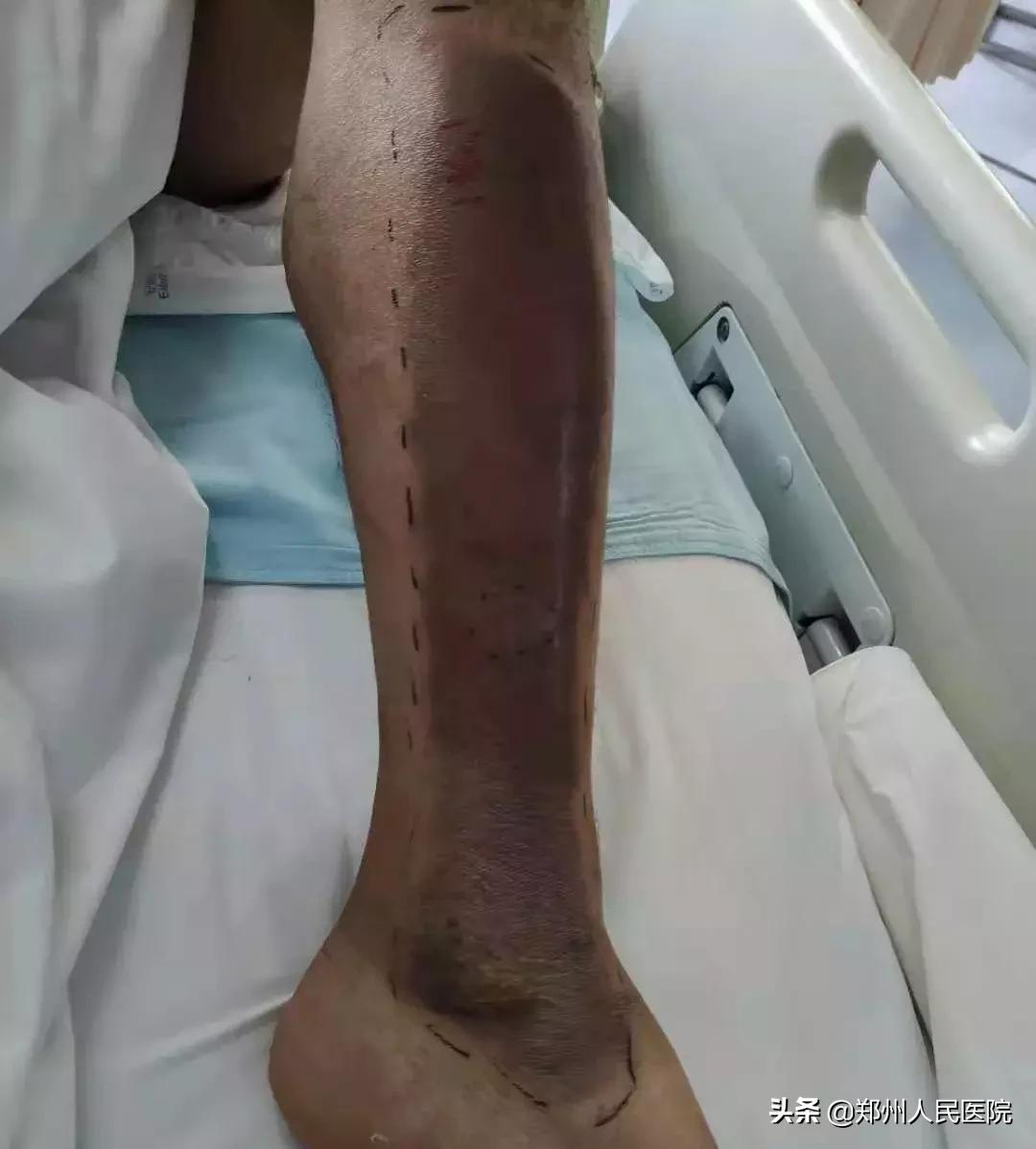 “砰”的一声，我把自己送进了ICU—“一位电击伤患者的自述”