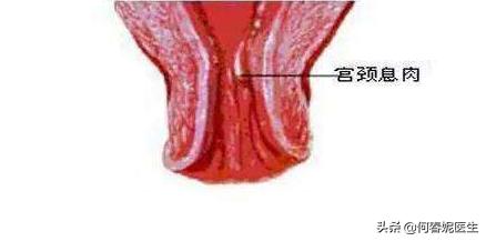 宫颈癌触碰后出血症状,宫颈糜烂出血是宫颈癌吗