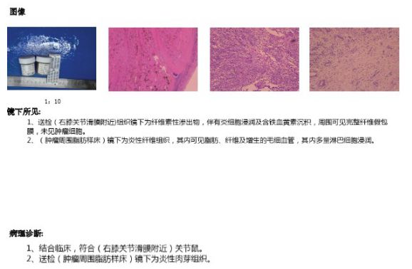 膝关节外侧肿胀且反复发作,神秘原因导致单侧膝关节反复肿胀