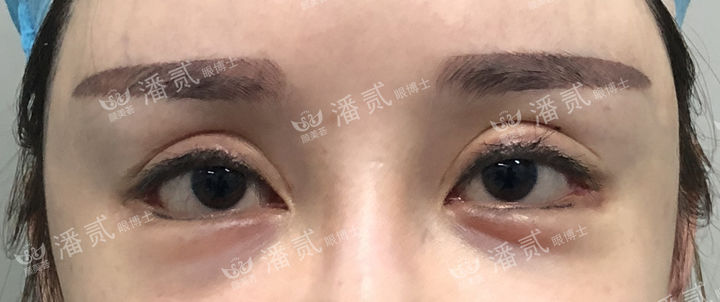 开外眼角会有哪些后遗症,开外眼角的手术后的图片