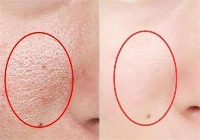 毛孔粗大如何改善最有效的方法,毛孔粗大目前最有效的方法