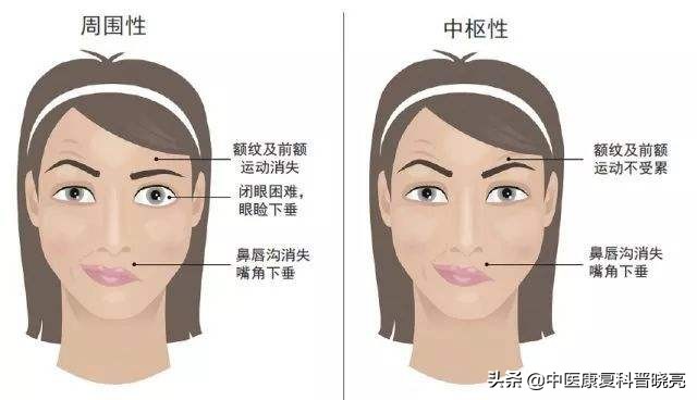 轻微面瘫的10大忌,面瘫最怕的四个误区