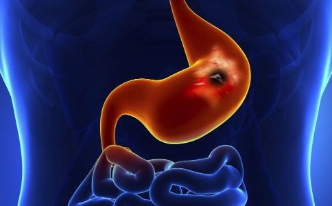 胃溃疡严重还是胃溃烂严重,胃溃疡烂了很严重要切胃吗