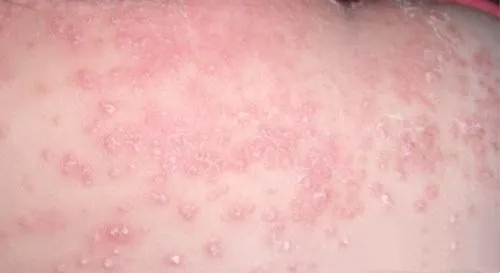 湿疹折磨人吗,皮肤科医生教你认识湿疹