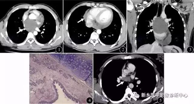 肺部有球形病灶怎么治疗,肺内多发结节诊断早期肺癌怎么办