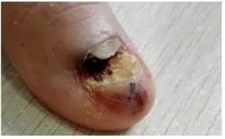 指甲问题对应身体哪里有问题,指甲的各种病变及解决办法